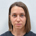 Трансконъюнктивальная блефаропластика - после