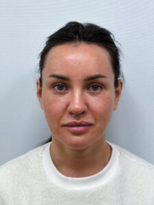 Круговая блефаропластика + эндоскопический лифтинг - после