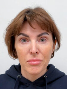 Трансконъюнктивальная блефаропластика - после