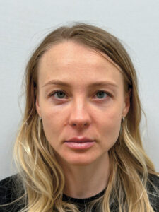 Трансконъюнктивальная блефаропластика - после