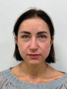 Эндоскопический лифтинг в сочетании с круговой блефаропластикой - после