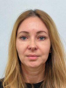 Эндоскопический лифтинг в сочетании с круговой блефаропластикой - после