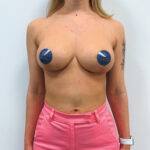 Редукционная маммопластика с подтяжкой без имплантации - после