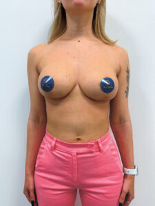 Редукционная маммопластика с подтяжкой без имплантации - после