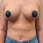 Редукционная маммопластика с подтяжкой без имплантации - после