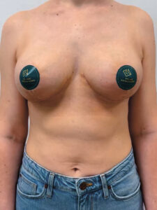 Редукционная маммопластика с подтяжкой без имплантации - после