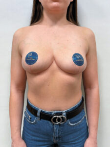 Редукционная маммопластика с подтяжкой без имплантации - после