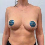 Редукционная маммопластика с подтяжкой без имплантации - после