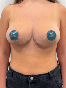 Редукционная маммопластика с подтяжкой без имплантации - после