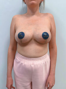 Редукционная маммопластика с подтяжкой без имплантации - после