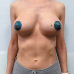 Реэндопротезирование - после