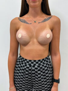 Маммопластика увеличение - после