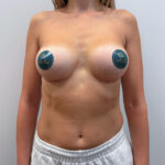 Маммопластика увеличение - после