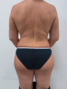 Липосакция - после