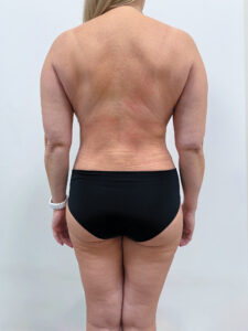 Липосакция - после