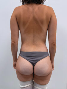 Бодилифт с липомоделированием - после