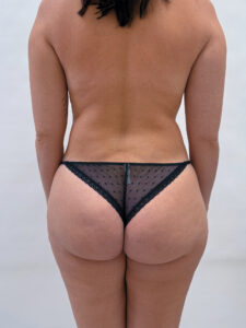 Липосакция - после