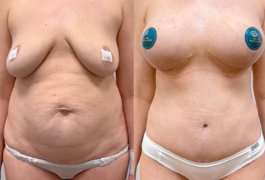 Подтяжка с имплантацией и бодилифт. До и после. Халилуллин Р.И.