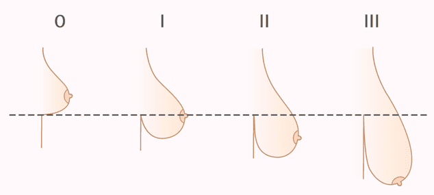 Степени птоза груди. Хирург Халилуллин Р.И.