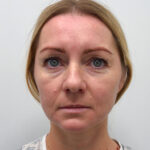 Эндоскопия с блефаропластикой - до