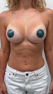 Увеличение груди - после