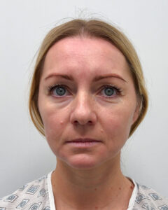 Эндоскопия с блефаропластикой - до