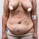 Бодилифт + якорная подтяжка с имплантацией. - до