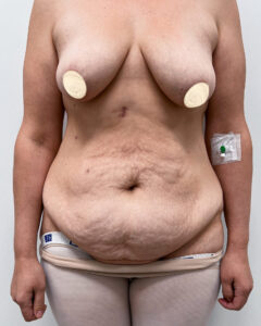 Бодилифт + якорная подтяжка с имплантацией. - до