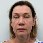 СМАС + эндоскопия 2/3 - до