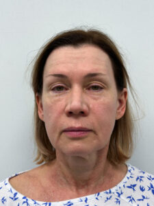 СМАС + эндоскопия 2/3 - до