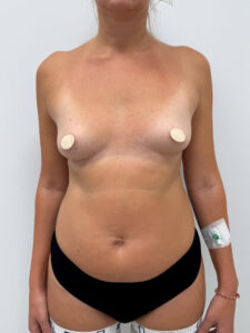 Маммопластика увеличение - до