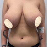Редукционная маммопластика - до