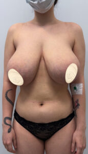 Редукционная маммопластика - до