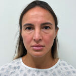 Периорбитопластика - до