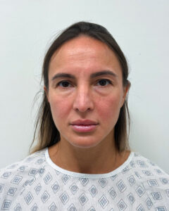 Периорбитопластика - до