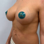 Якорная подтяжка с имплантатами - после