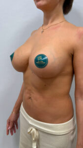 Якорная подтяжка с имплантатами - после