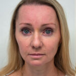 Эндоскопия с блефаропластикой - после