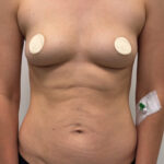 Увеличение груди - до