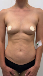 Увеличение груди - до