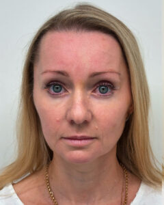 Эндоскопия с блефаропластикой - после