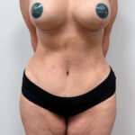 Бодилифт + якорная подтяжка с имплантацией. - после