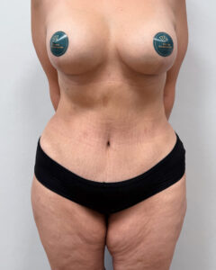 Бодилифт + якорная подтяжка с имплантацией. - после