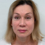 СМАС + эндоскопия 2/3 - после