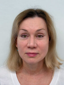 СМАС + эндоскопия 2/3 - после