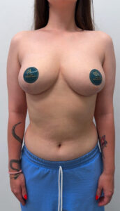 Редукционная маммопластика - после