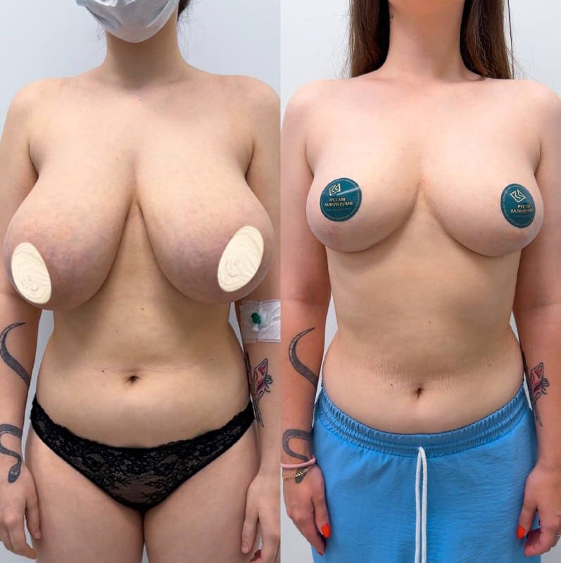Редукционная маммопластика. До и после. Халилуллин Р.И.