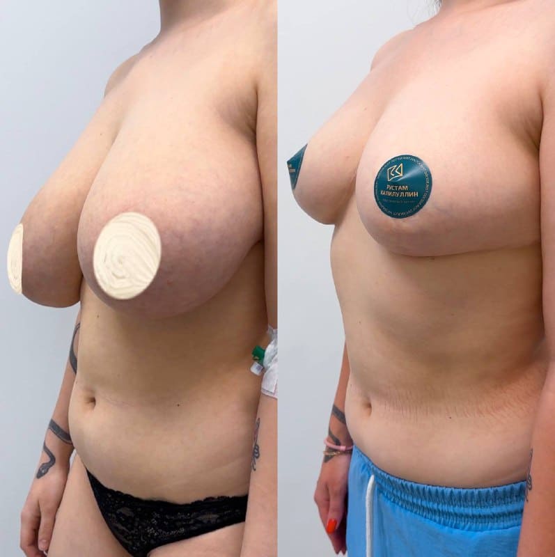 До и после редукционной маммопластики. Халилуллин Р.И.
