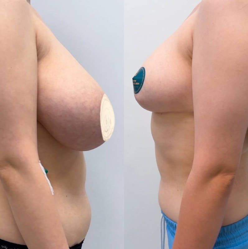 Редукционная маммопластика при гипертрофии. Халилуллин Р.И.