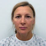 Эндоскопическая подтяжка лица - до